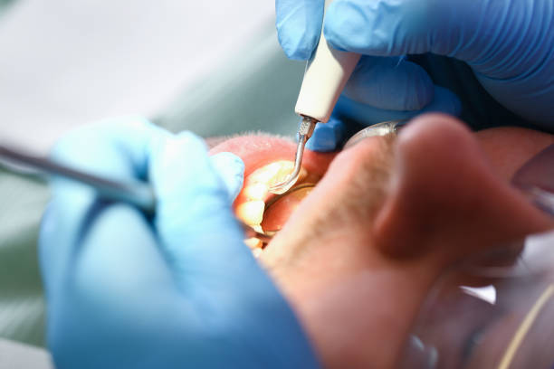 Best Emergency Wisdom Teeth Removal in Covington, OH